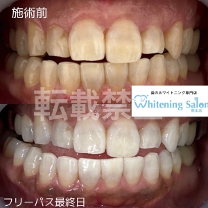 【ホワイトニングにも学割？！】