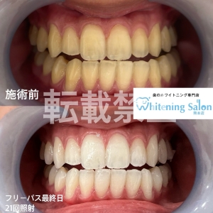 【ホワイトニングで化粧映え】