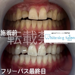 【歯の白さを維持するためには？？】