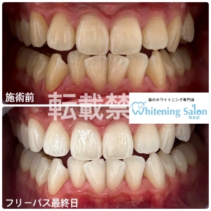 【低価格で手軽にホワイトニング】