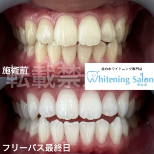 【食生活で歯周病予防】