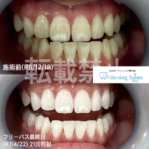 【光触媒を利用したホワイトニング】