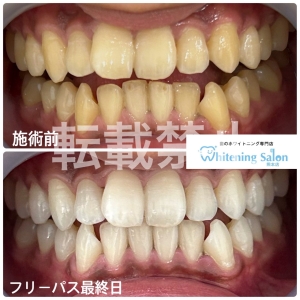 【歯の黄ばみの種類や原因は？】