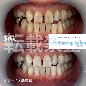 【セルフホワイトニングの特徴】