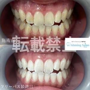 【虫歯予防】