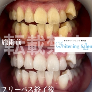 【ぐらつく歯】