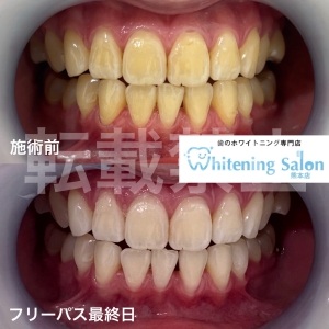 【炭酸水は歯に悪影響？】