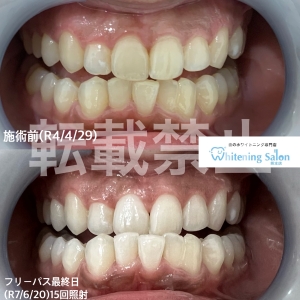 【フリーパスコースでお得に歯を白くしてみませんか？】