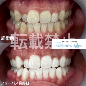 【ホワイトスポットとは？？】