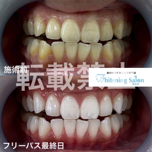【歯並び】