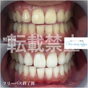 【ホワイトニングを繰り返すとどうなる？】