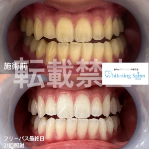 【ホワイトにングは何年くらい持ちますか？】