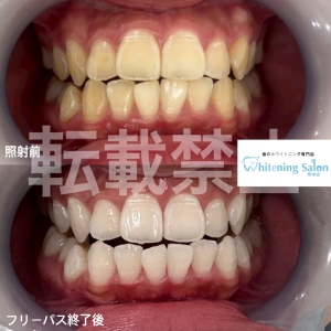 【セルフホワイトニング何日おき？】