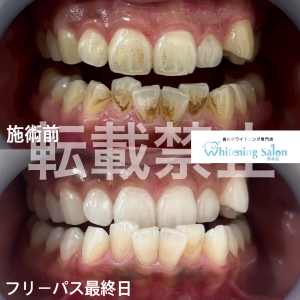 【コーヒー、お茶好きの方でも白くなります！⠀】