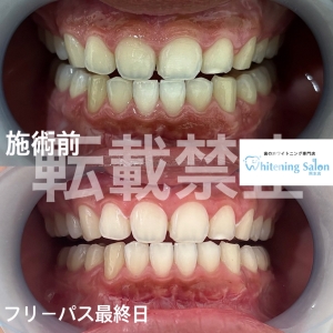 【セルフホワイトニングは1回何分かかりますか？】