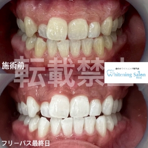 【ホワイトニングは体に悪影響ですか？】