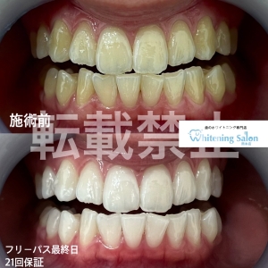 【ホワイトスポットとは？？】