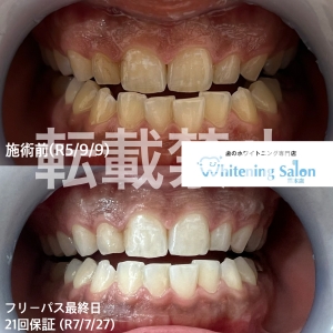 【ホワイトニング終了後は？】