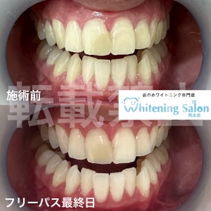 【歯周病と虫歯の違いとは？】