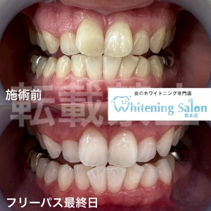 【歯ブラシの交換時期】