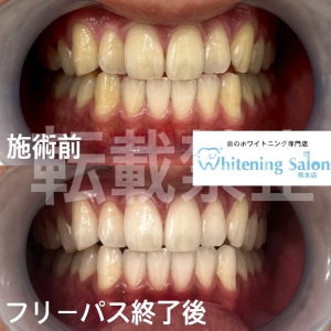 【歯間ブラシ】
