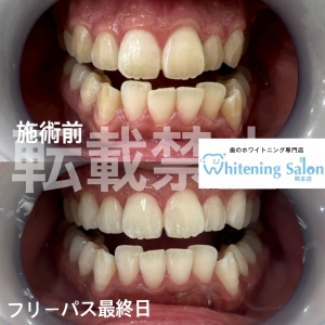 【併用してホワイトニングできる？】