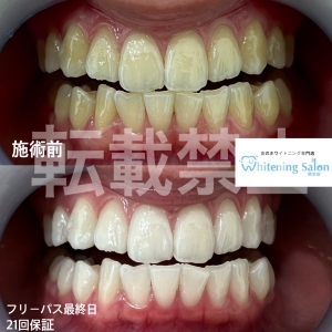 【銀歯があってもホワイトニングはできますか？】