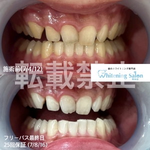 【市販のホワイトニング歯磨き粉で歯を白くできるの？】