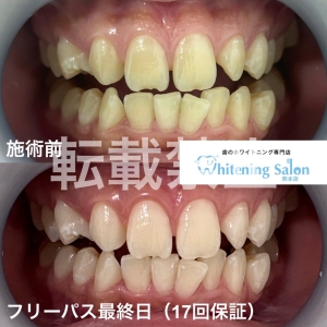【歯周病って治るの？】
