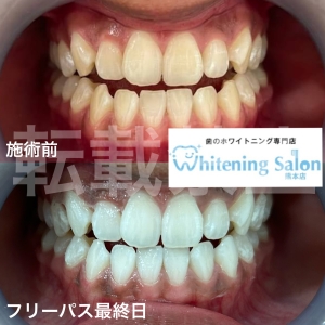 【災害時の口腔ケア】