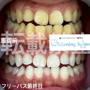 【人気の回数券メニュー】熊本/ホワイトニング