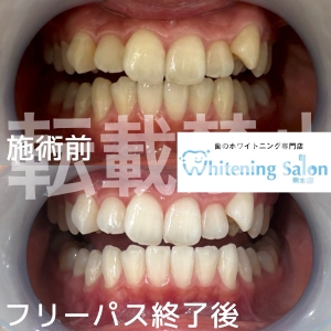 【歯に穴が開く原因】