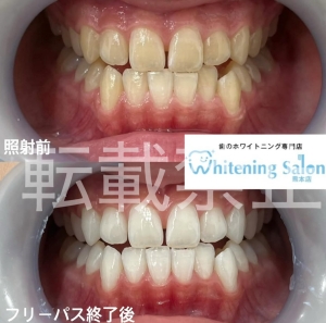 【親知らずとは？】