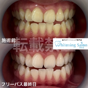 【ホワイトスポットとは】