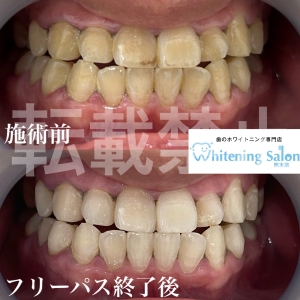 【歯磨き粉の適正量は？】