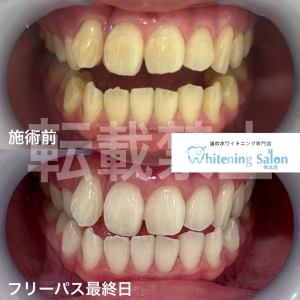 【歯のお手入れについて】熊本/ホワイトニング