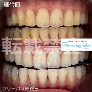 【セルフホワイトニング何日おき？】
