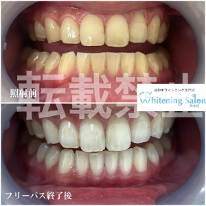 【ご予約はお早めに☆】熊本/ホワイトニング