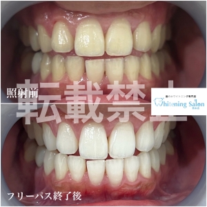 【正しい歯磨き】熊本/ホワイトニング