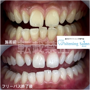 【ホワイトニングは年齢制限なし】熊本/ホワイトニング