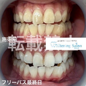 【LINEからもご予約可能です☆】熊本/ホワイトニング