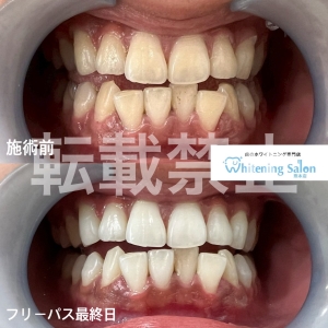 【歯ブラシを交換する理由 】熊本/ホワイトニング