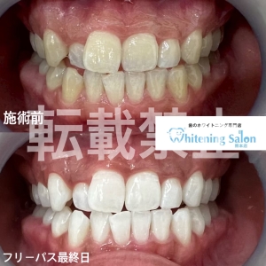 【当店のホワイトニング剤について】熊本/ホワイトニング