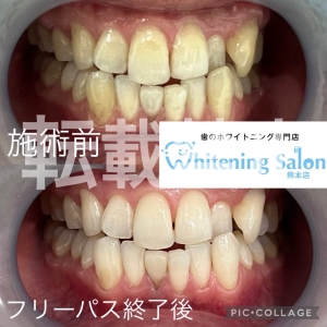 【歯は大切？】熊本/ホワイトニング