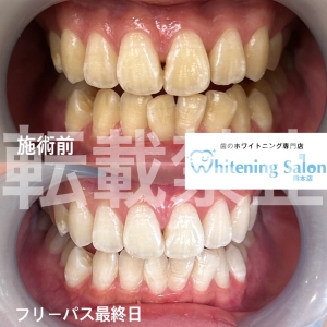 【セルフホワイトニング 何日おき？】熊本/ホワイトニング