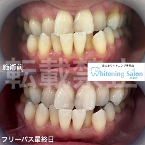 【今日からできる歯に良い習慣】熊本/ホワイトニング