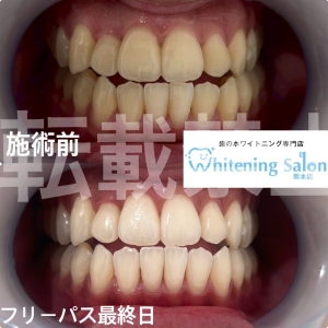 【ステイン】熊本/ホワイトニング