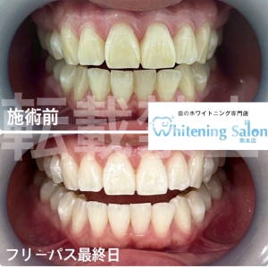 【口内炎】熊本/ホワイトニング