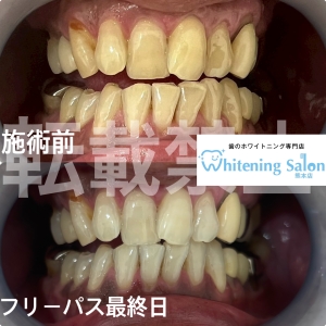 【歯が溶ける原因】熊本/ホワイトニング