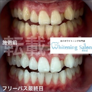 【よく噛むことは歯にも大事】熊本/ホワイトニング